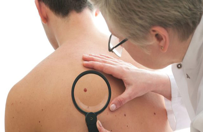 خمس علامات إنذار مبكر لأكثر أشكال سرطان الجلد انتشارا