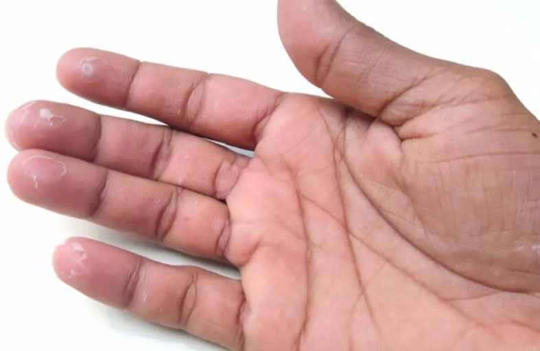 علامة على الأصابع قد تكشف سرطان الرئة مبكرًا