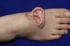 أذن تنمو في قدم امرأة ثم تُعاد لمكانها الطبيعي في إنجاز طبي لافت