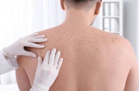سرطان الجلد.. ثمانية علامات رئيسية تحذر من أن الشامة قد تكون سرطانية!