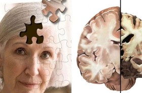 اكتشاف طريقة لإنعاش الدماغ في حال الإصابة بالخرف