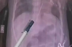 إبرة خياطة تخترق قلب طفلة 