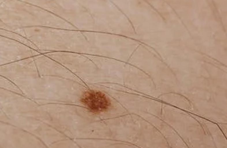 سرطان الجلد.. هذه العلامة دليلك للكشف المبكر