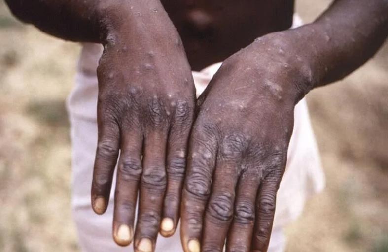 السودان يرصد 5 حالات لجدري القرود
