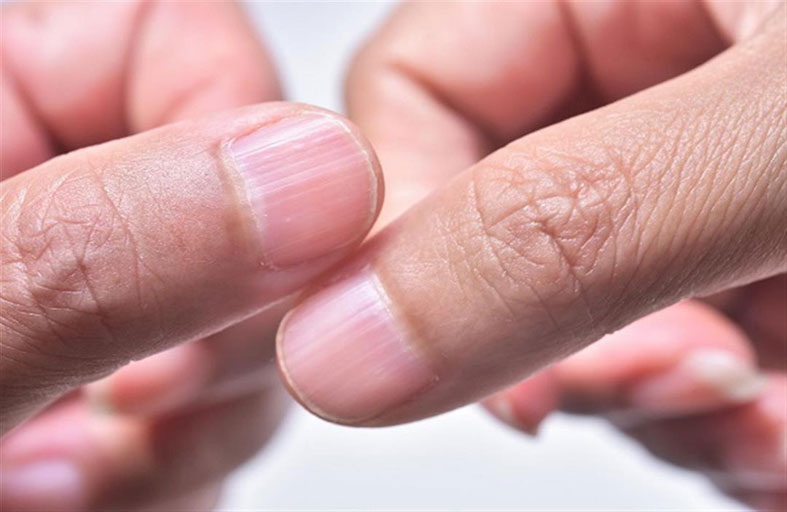 أربع علامات على اليد قد تكون من أعراض مرض الكبد الدهني!
