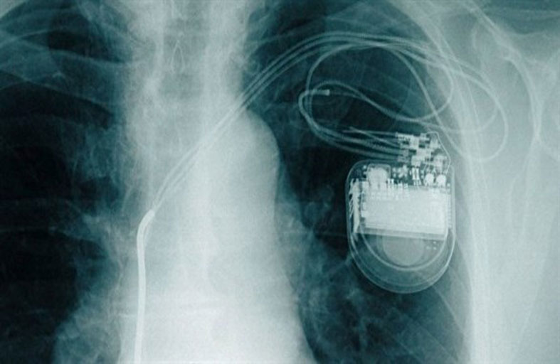الأجهزة الإلكترونية قد تؤثر على منظم ضربات القلب