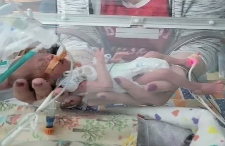 طفلة ولدت بمريء منفصل 