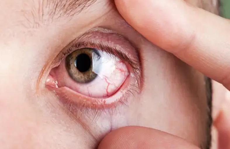 أعراض غير واضحة لسرطان العين