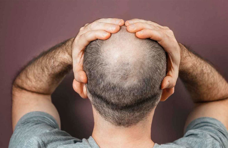 تتهم زوجها بخداعها وإخفاء «صلعه»