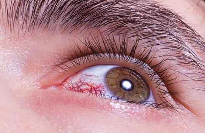 نصائح فعالة لحماية عيون مرضى السكر