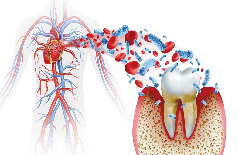 كيف يؤثر تسوس الأسنان على صحة القلب؟!