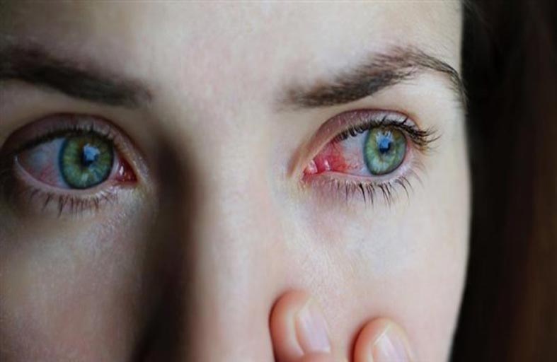 نصائح لعلاج التهاب ملتحمة العين
