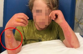 بسبب الليمون.. طفل يتعرض لحرق مروع