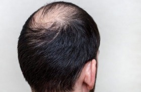 الجد له دور رئيسي في تساقط الشعر الوراثي