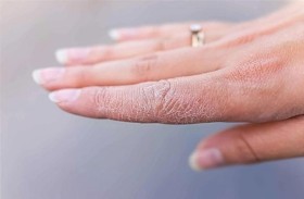 لماذا يزداد خطر الجفاف في الشتاء؟