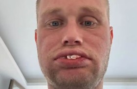 فقد جميع أسنانه بعد رحلة علاج