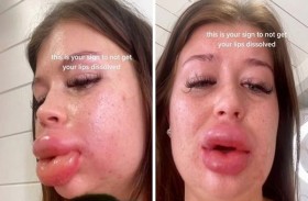 نتيجة كارثية لامرأة حاولت إزالة الفيلر من شفتيها