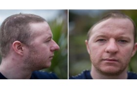 لكمة واحدة تُفقده نصف جمجمته