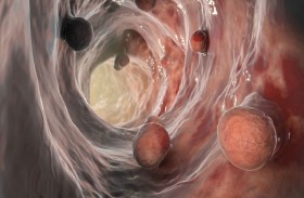 مشروبات شائعة الاستهلاك تضاعف خطر الإصابة بسرطان الأمعاء