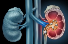 الأنظمة الغذائية التي تحتوي على البوتاسيوم والكالسيوم تمنع تشكل الحصوات الكلوية