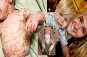 طفل يدمن الستيرويدات بسبب الأكزيما
