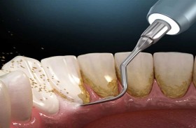 ثلاث خطوات يومية تخلصنا من الترسبات على الأسنان