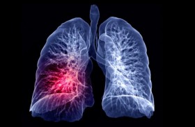 دراسة تكشف سبب عدم إصابة معظم المدخنين بسرطان الرئة