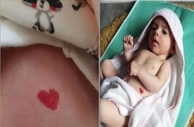 طفلة تولد بوحمة على شكل قلب