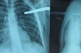 إخراج قضيب حديدي من صدر مريض