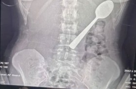 امرأة تبتلع ملعقة بالخطأ