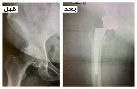 نجاح السعودي الألماني دبي في استبدال مفصل الورك لمريضة خمسينية 