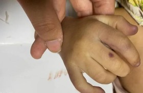 جراحة صعبة لإعادة ذراع مبتورة لطفلة 