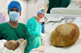 إزالة حصوة عملاقة من مثانة رجل