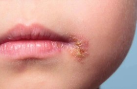 عدوى جلدية شائعة يُساء تشخيصها.. كيف تعرفها قبل أن تتفاقم؟