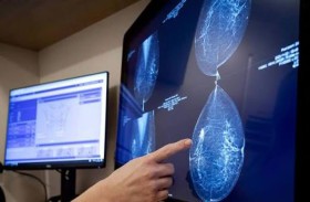 نموذج ذكاء اصطناعي يتنبأ بسرطان الثدي قبل 10 سنوات من الإصابة