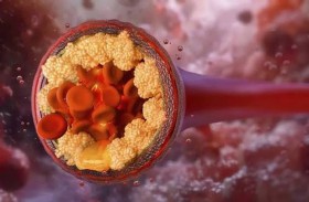 حمية غذائية شائعة قد تسبب ارتفاعا خطيرا في الكوليسترول