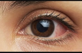 نتائج مشجعة لعلاج أكثر سرطانات العين شيوعا