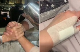 «تريند» صادم يحرق أجساد المراهقين