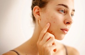 علاج طبيعي لمشكلات البشرة وحب الشباب