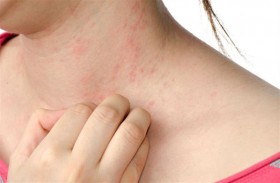 هل تمثل أمراض الجلد مؤشرا على الإصابة بالوباء؟