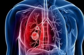 لماذا لا يصاب معظم المدخنين بسرطان الرئة؟