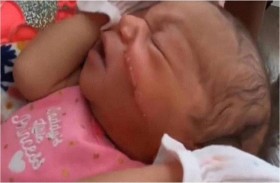 ولادة طفلة بجرح قطعي في الوجه