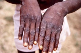 بعد صدمة كورونا... هل يمكن احتواء جدري القردة؟