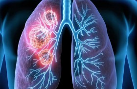 دراسة حديثة: تلوث الهواء مرتبط بسرطانات الرئة 