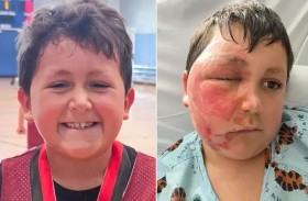 إصابة خطيرة لطفل بعد تقليد على «تيك توك» 