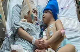 فصل توأمين بتقنية الواقع الافتراضي 