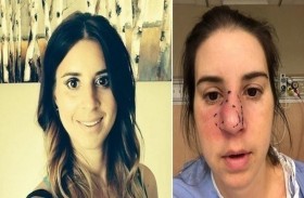 تزيل أنفها بالكامل بسبب آلامها المبرحة