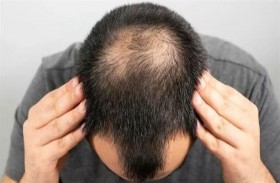 لصاقة ثورية لعلاج الصلع
