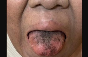 ينمو الشعر على لسانها بسبب مضاد حيوي 