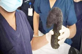 كرة شعر كبيرة في معدة طفلة